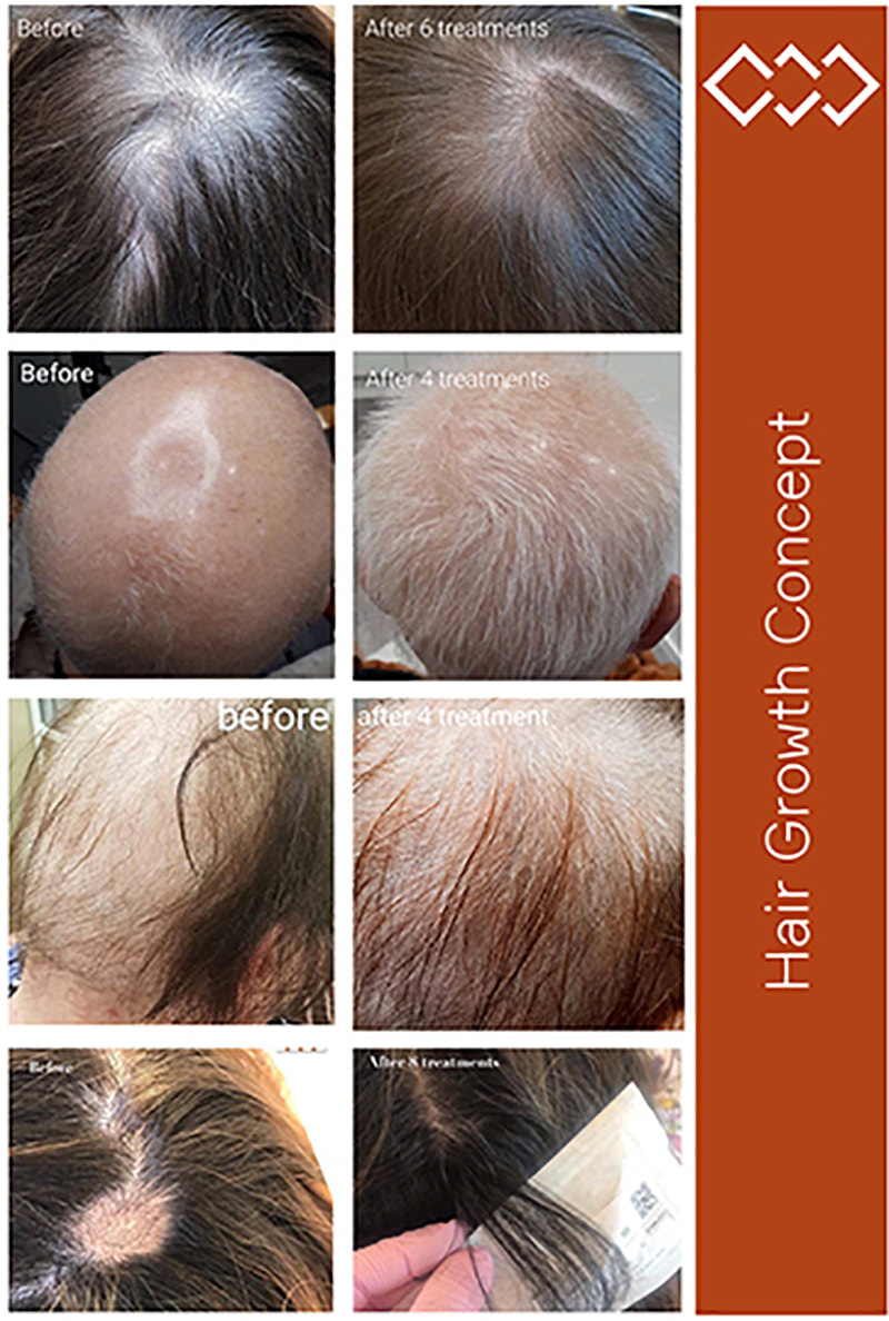 Meso Hair loss control - Kleopatra Hudplejeklinik